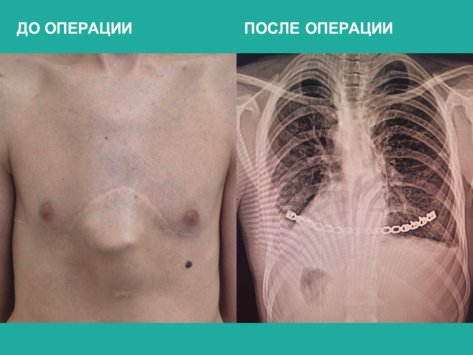 Кировские врачи устранили деформацию грудной клетки 14-летнему подростку
