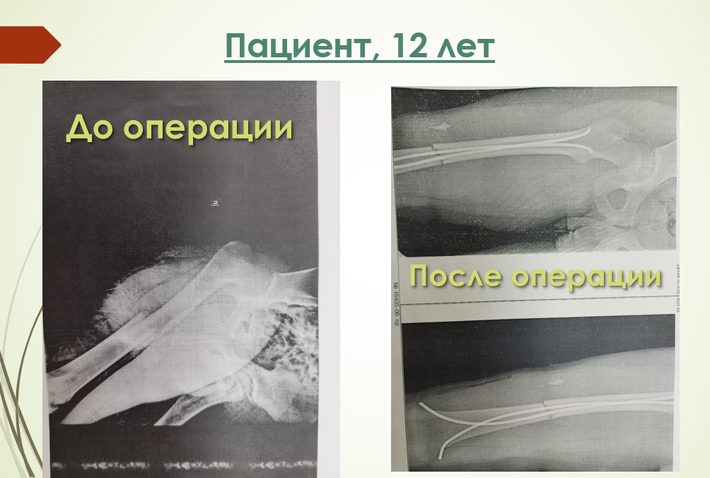 Кировские врачи напоминают о правилах безопасности при передвижении на велосипедах и самокатах