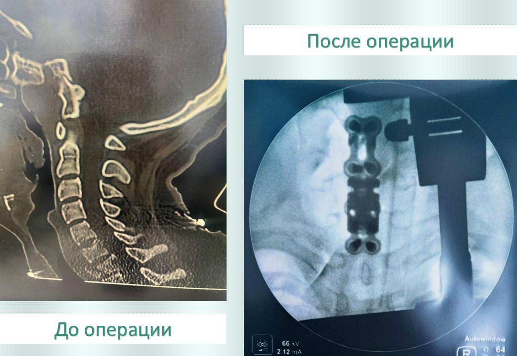 Кировские врачи вернули подростку возможность движения после тяжелой травмы