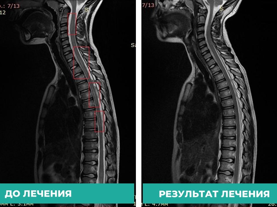 В Кировской детской областной больнице спасли ребенка с серьезным заболеванием