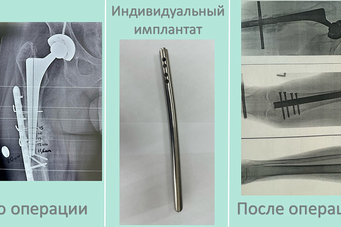 Кировские врачи впервые провели операцию по уникальной методике