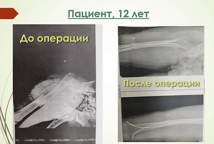 Кировские врачи напоминают о правилах безопасности при передвижении на велосипедах и самокатах