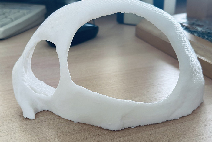 Кировские хирурги распечатали макет черепа пациента на 3D-принтере для подготовки к операции