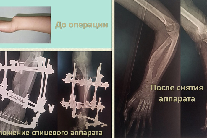 Кировские врачи исправили близнецам редкую деформацию Маделунга
